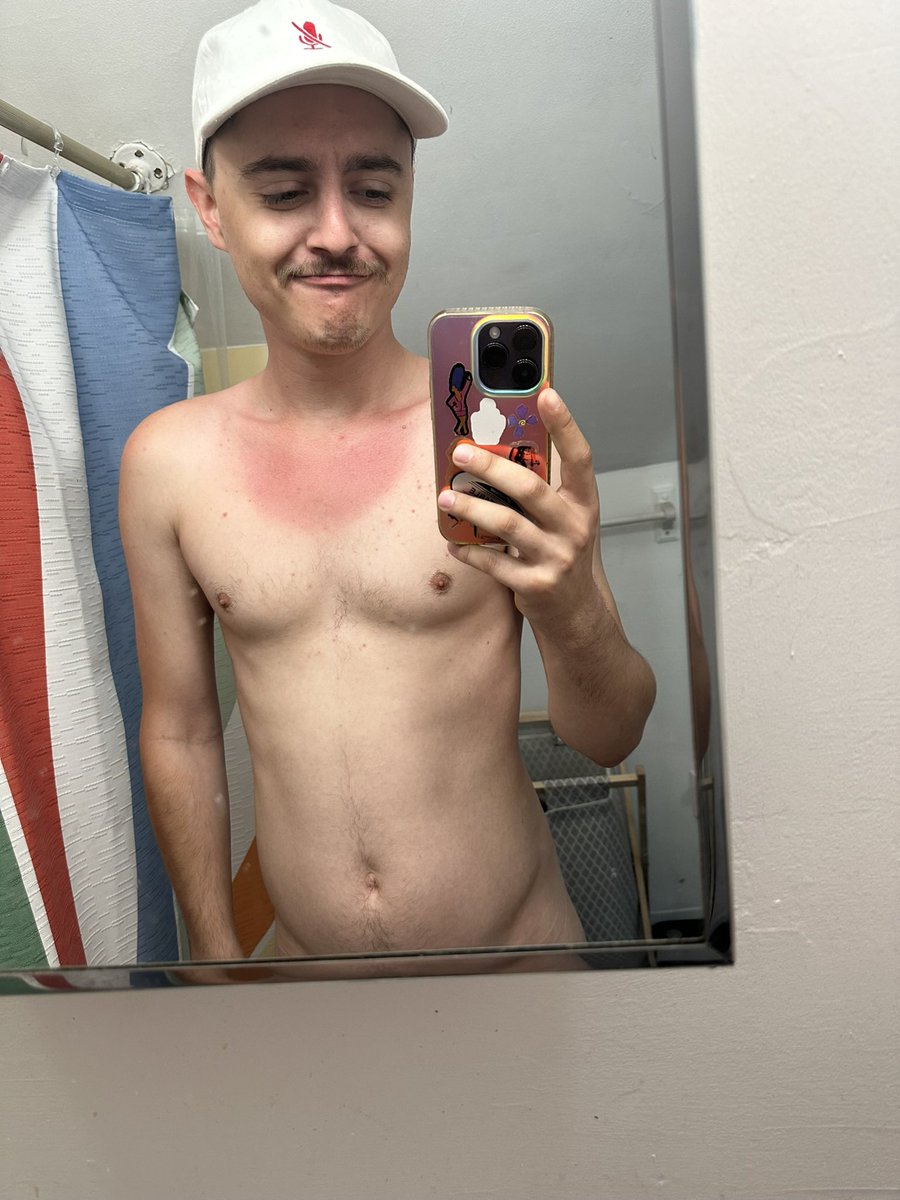 The sun roasted me yesterday 🥴