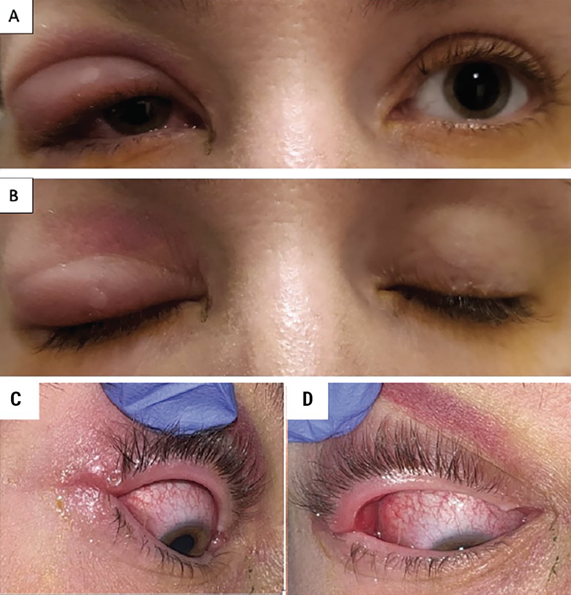 June 2024 Wills Eye Resident Case Series: A chalazion masquerader presents at Wills’ ER in a 36-year-old female: reviewofophthalmology.com/article/june-2…
@wills_eye 
#willseye #willseyehospital #ophthalmology #eyecare #eyedoctor #eyedoc #ophthalmologist #vision