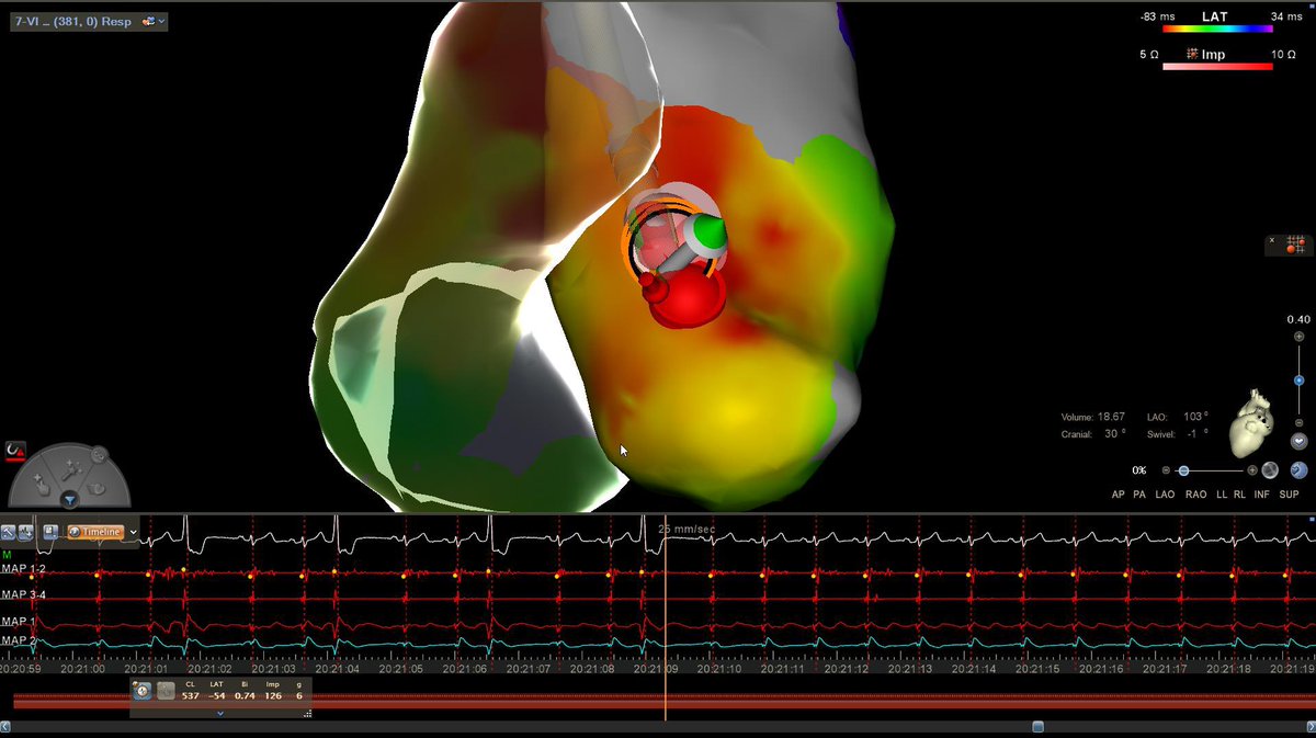 OscarVazquezEP's tweet photo. LV Summit VT ablation, performed by @Jorge_leal31. One of the most promising #Mexico EP fellows #YoungEP. Well done! Keep it going! #ZeroFluoro https://t.co/2dE5kNbwJG
