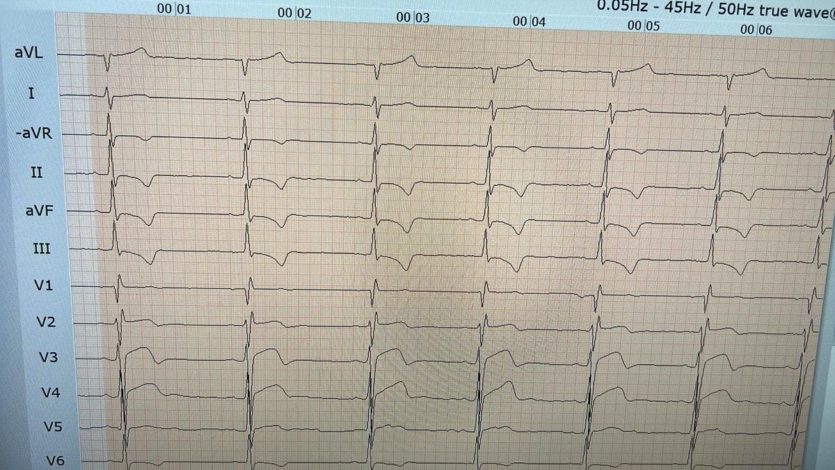 Nader Joghetaei, MD (@naderjo) on Twitter photo Apparently healthy 23 yo male, incidental #ekg, subsequent #echofirst w mild concentric hypertrophy. Thoughts? <a href="/smithECGBlog/">Stephen W. Smith</a> <a href="/ecgandrhythmRoe/">Dr. Andreas Roeschl</a> <a href="/narrowQRS/">JMC</a> <a href="/ecgrhythms/">Arnel Carmona</a> Apparently healthy 23 yo male, incidental #ekg, subsequent #echofirst w mild concentric hypertrophy. Thoughts? <a href="/smithECGBlog/">Stephen W. Smith</a> <a href="/ecgandrhythmRoe/">Dr. Andreas Roeschl</a> <a href="/narrowQRS/">JMC</a> <a href="/ecgrhythms/">Arnel Carmona</a>