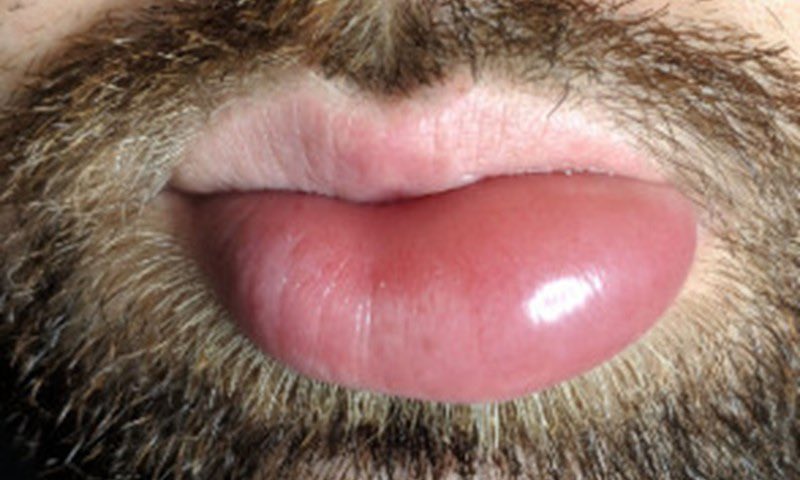 ImmunoTea: Your Immunology Podcast (@immunotea) on Twitter photo Our latest episode is out today! We spoke to <a href="/_hilarylonghurs/">Hilary Longhurst</a> all about #HereditaryAngioedema and the amazing new treatments coming down the line! Download now wherever you get your podcasts by searching ImmunoTea! Our latest episode is out today! We spoke to <a href="/_hilarylonghurs/">Hilary Longhurst</a> all about #HereditaryAngioedema and the amazing new treatments coming down the line! Download now wherever you get your podcasts by searching ImmunoTea!