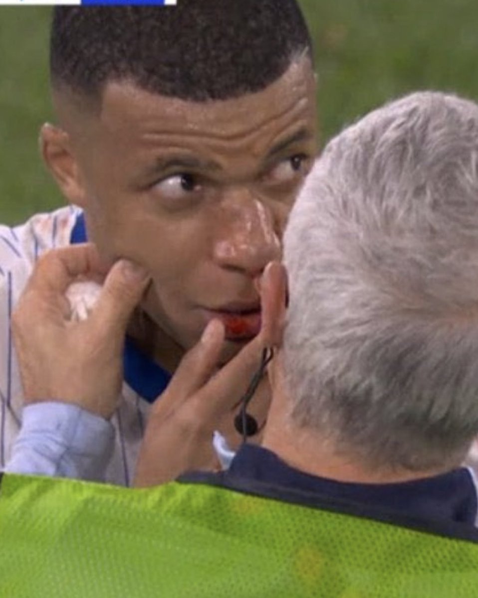 theMadridZone's tweet photo. 🚨 Kylian Mbappé's nose looks in a really bad situation... https://t.co/rNW679z69w