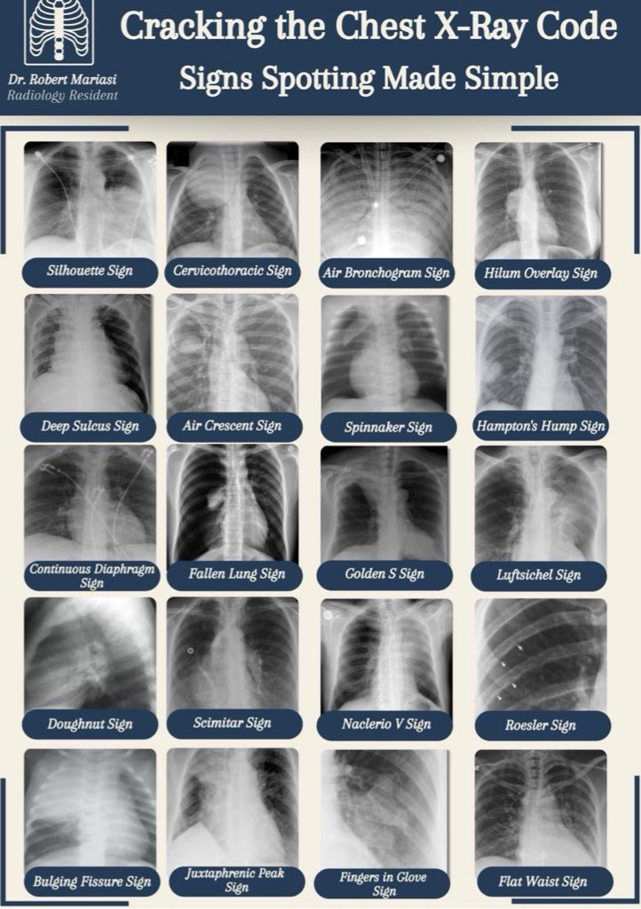 Chest X-ray signs <a href="/OGdukeneurosurg/">Oren Gottfried, MD</a> (Robert Mariasi) #MedX