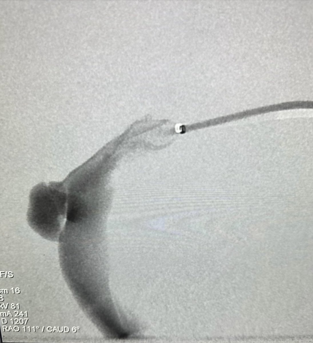 PenNeuro's tweet photo. US HCPs: #MIDWAY 43 tracking to the transverse sinus to deliver 4 #PC400 .020โ coils for a 41% packing density of 8 mm venous diverticulum. System supported with #BENCHMARK 071. Courtesy of Dr. Goyal and @bmulpur!
Rx only. Risk: https://t.co/hzWEQEQmfZ Clinical results may var https://t.co/sUoqgAkdZp