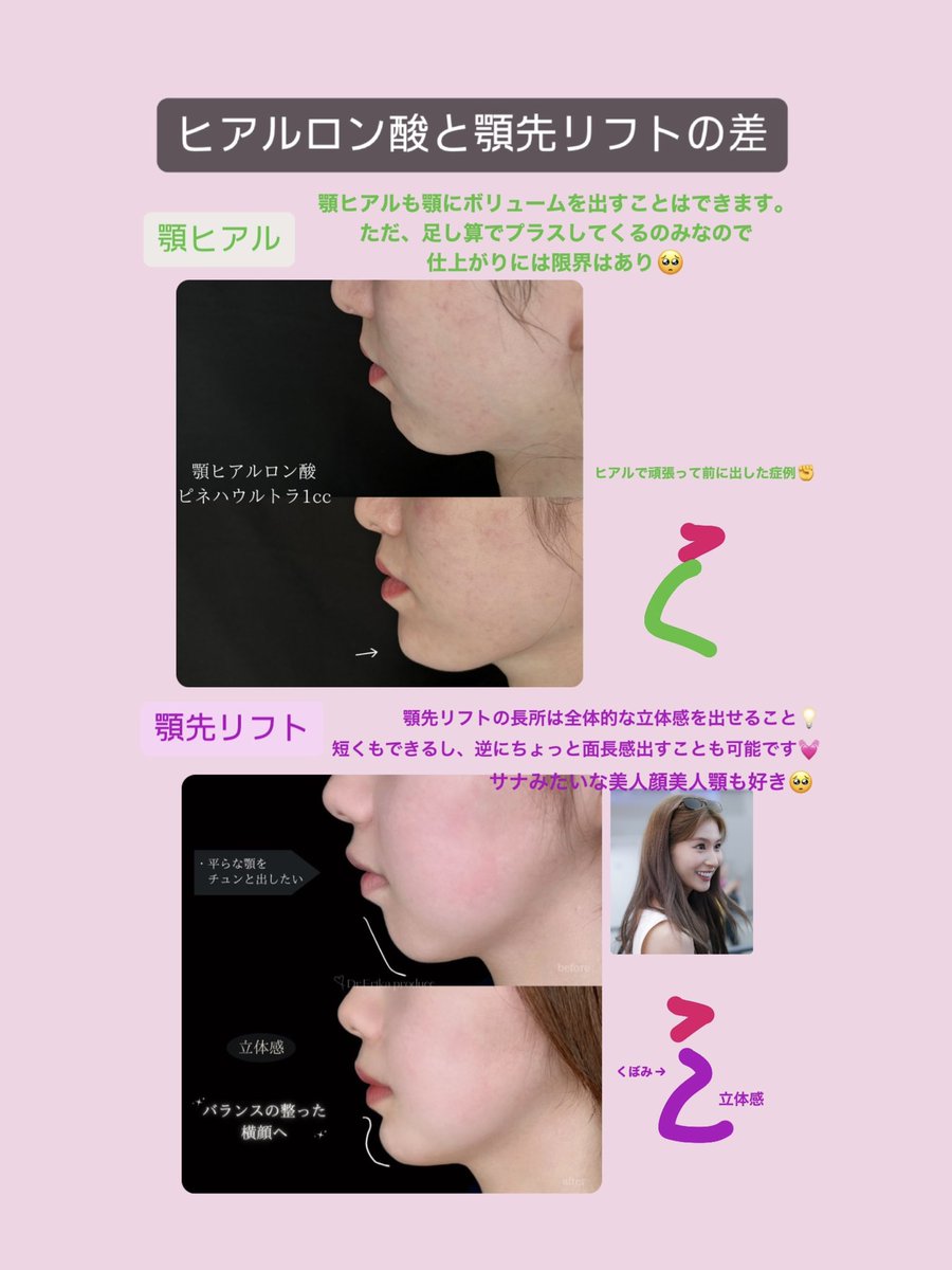 aladdin_drErika's tweet photo. ツイートありがとうございます🥲
実際に私も顎ヒアルロン酸で顎が垂れ下がり城之内アゴになった経験があります笑
（2枚目）

顎先リフトは…
・自然な立体感を出すことができる
・顎の向きなどミリ単位でデザイン調整可能
・DTが軽い
のがメリット✨

オトガイ形成はDTも壮絶で簡単に修正はできません https://t.co/dO4y7noSdX