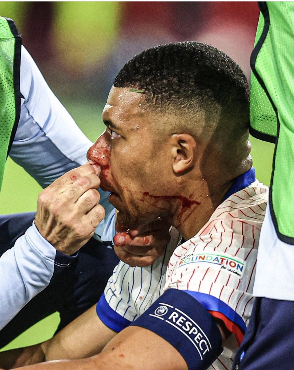 Thatsportsspice's tweet photo. RT if you’ve ever had your nose broken 😖 https://t.co/4dNk4pNjVG