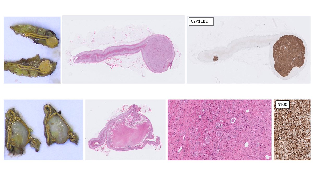 Multiple aldosterone producing nodules are associated with an increased risk of biochemical recurrence in the contralateral adrenal (top row). This specimen also contained an unrelated ganglioneuroma (bottom row) with typical macroscopic/microscopic features. #endopath #GUpath