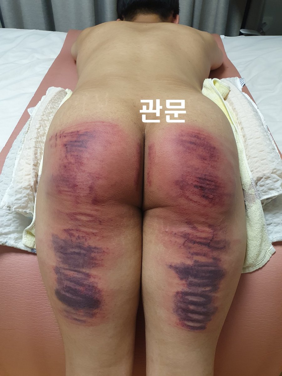 gateofspank's tweet photo. 멜투멜#10
엉덩이부터 허벅지까지 조져버리기.
오른쪽은 얼음팩 찜질 및 애프터케어후.
케인부터 pvc파이프까지 골고루 200대. https://t.co/fJY4poOwtq