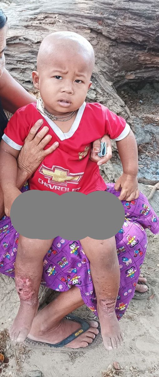 ArakanBaynews's tweet photo. Diarrhea, skin diseases and other infectious disease outbreaks are happening in many IDP places across Rakhine. A few fatalities have been reported in many cases. Over 500,000 people are taking shelter in IDP places and children are facing many vulnerabilities.
#HDCO #Kyautphyu #Rakhine #Arakan #Myanmar
@UNICEF
@UN
@WHO
@BBCWorld
@bbcburmese
@nytimes
@cnni
@DeutscheWelle
@UKParliament
@HouseofCommons
@ASEAN
@UKMissionGeneva
@usmissiongeneva
@swiss_un
@SwissMFA
@FCDOGovUK
@MofaJapan_en
@StateDept
@FoxNews
@ICRC
@NHK
@indiandiplomats