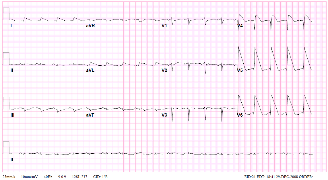 IhabFathiSulima's tweet image. A 55 lady in #cardiogenic_shock,
What are  the #ECG changes ?
What is the #prognosis ?
#MedTwitter
#card #cardio