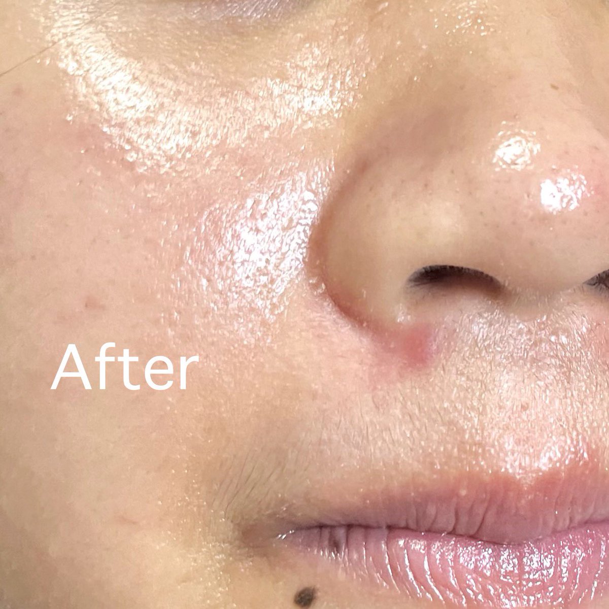 ลาโรชทำถึงมากกกกกก!! เป็นปจด.แล้วสิวอักเสบขึ้นเม็ดใหญ่มากยุบยากด้วยอะ แต่หยิบหลอดนี้มาทาเลย เป็น Effaclar Duo+M สูตรใหม่เพิ่ม Phylobioma ช่วยจัดการสิวได้ปังกว่าเดิม  ชั้นอะทานางตอนก่อนนอน ตื่นเช้ามาคือยุบไวจริงๆๆ แค่8ชม.เองกรี้ดดดด #ใช้ดีบอกต่อ #HowtoPerfectสิว
#LaRochePosayTH