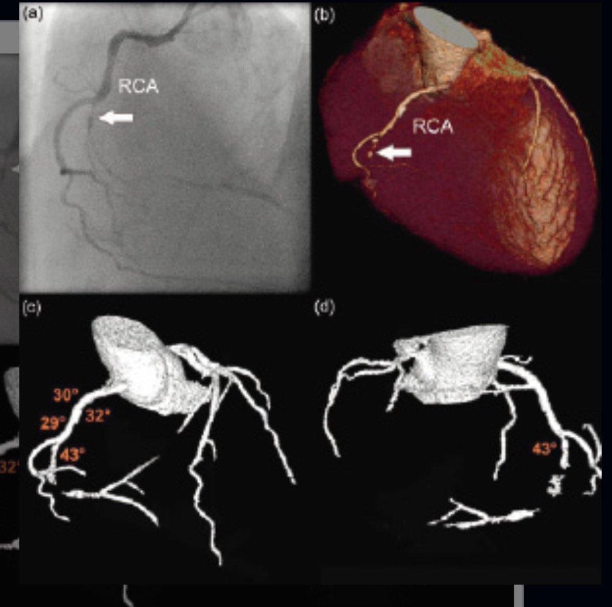 Prof. Hector M. Garcia-Garcia (@hect2701) on Twitter photo First we thought that #CTA would only be useful for guiding #CTO procedures👇
eurointervention.pcronline.com/article/comput…
Fast forward to today… a practice changing course by <a href="/CoreAalst/">CoreAalst</a>
Visit 👉 coreaalst.com/ct-guided-pci-…
@bernardBruyne <a href="/ColletCarlos/">Carlos Collet MD PhD</a> <a href="/OptimaCTO/">Optima Education</a> <a href="/CardioAalst/">Hartcentrum Aalst</a> <a href="/Bhcintervention/">Dan Jones</a> First we thought that #CTA would only be useful for guiding #CTO procedures👇
eurointervention.pcronline.com/article/comput…
Fast forward to today… a practice changing course by <a href="/CoreAalst/">CoreAalst</a>
Visit 👉 coreaalst.com/ct-guided-pci-…
@bernardBruyne <a href="/ColletCarlos/">Carlos Collet MD PhD</a> <a href="/OptimaCTO/">Optima Education</a> <a href="/CardioAalst/">Hartcentrum Aalst</a> <a href="/Bhcintervention/">Dan Jones</a>