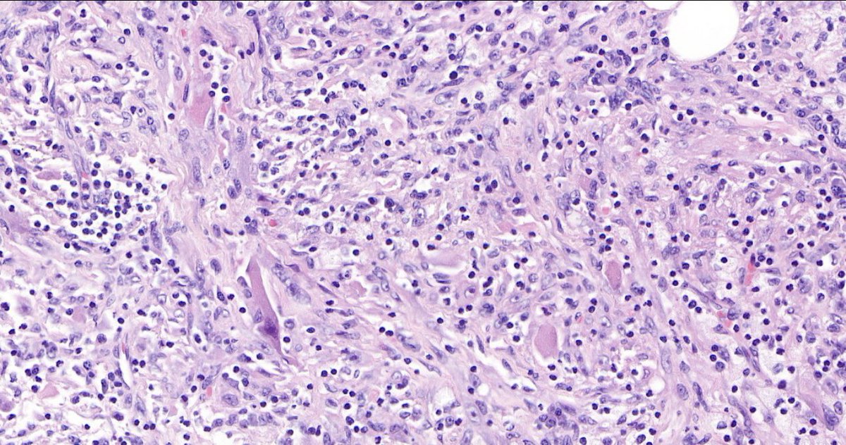MachadoIsidrin's tweet photo. 59 y/old/w, liver tumor (12mm). H&amp;E https://t.co/HHEa1zayxg