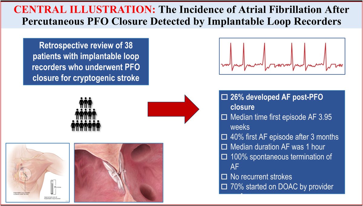MyJSCAI (@myjscai) on Twitter photo 📖True incidence of #AF after #PFO closure is unknown. In this retrospective study of pts w an #ImplantableLoopRecorder who underwent #PFOclosure, 26% developed AF post-PFO closure. Larger future trials are needed #AFib
➡️doi.org/10.1016/j.jsca…
<a href="/KomalImtiaz6/">Komal Imtiaz MD</a> 📖True incidence of #AF after #PFO closure is unknown. In this retrospective study of pts w an #ImplantableLoopRecorder who underwent #PFOclosure, 26% developed AF post-PFO closure. Larger future trials are needed #AFib
➡️doi.org/10.1016/j.jsca…
<a href="/KomalImtiaz6/">Komal Imtiaz MD</a>