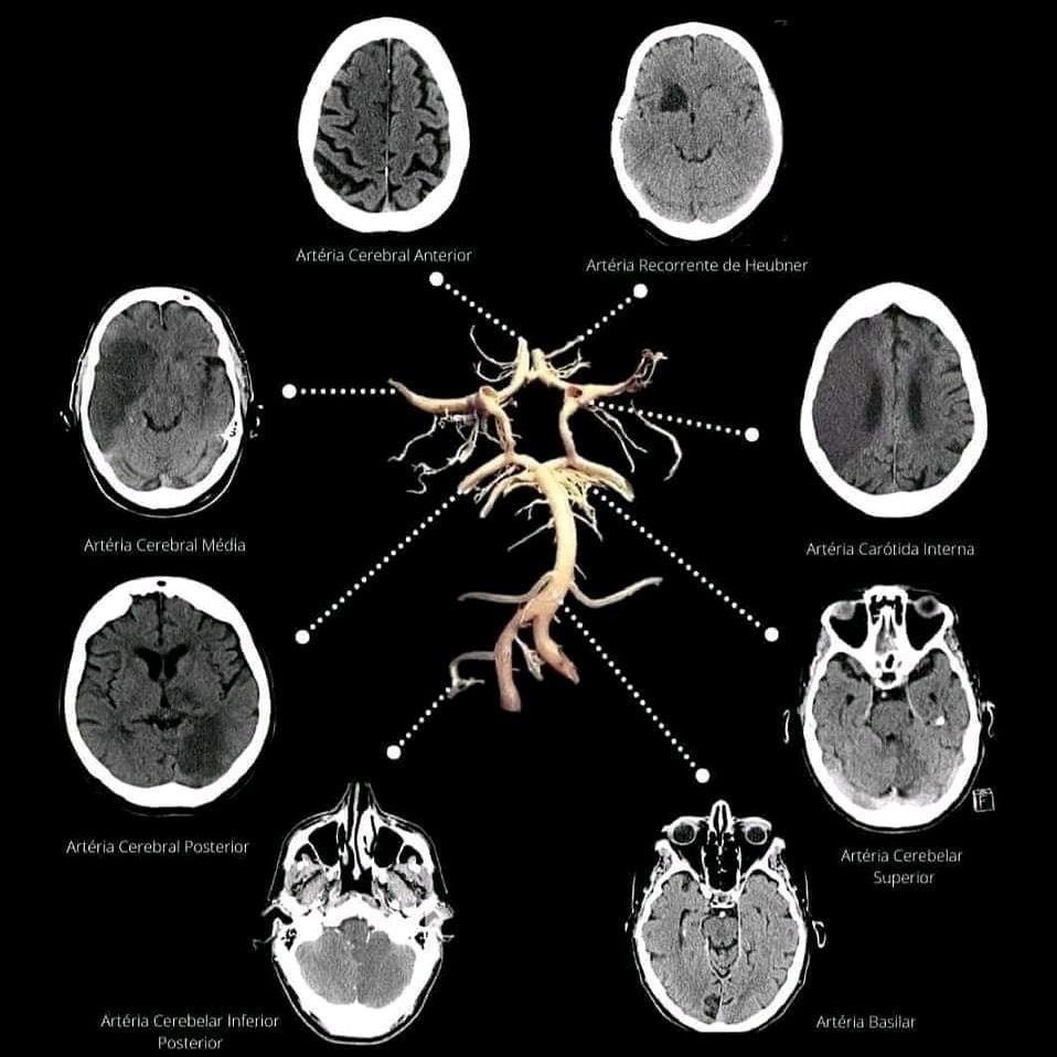 OGdukeneurosurg's tweet photo. Circle of Willis stroke distributions https://t.co/wyvIIJ9g8R