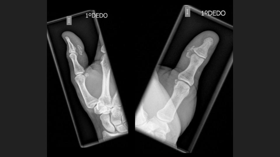 drwillyjara's tweet photo. 🖐 Varón de 51 años, dolor en 1er dedo.
🔍 Dx: Periartritis calcificante en fase de reabsorción espontánea, con inflamación en el borde palmorradial de la articulación interfalángica.
💡 La periartritis calcificante causa dolor por depósitos de calcio (hidroaxiapatita calcica). https://t.co/3EVFHckg9y