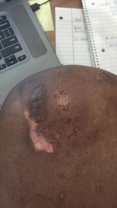 Well now they both hurt #instapotburns @instapot https://t.co/yKZ8FCrRJ6<a href="/tag/instapotburns"class="tags">&#35;instapotburns</a><a class="tags" target="_blank" title="On Twitter" href="/?out=eyJ0eXAiOiJKV1QiLCJhbGciOiJIUzUxMiJ9.eyJpYXQiOjE3MjQ0MzkzNzAsImlzcyI6InR3cG9ybnN0YXJzLmNvbSIsIm5iZiI6MTcyNDQzOTM3MCwiZXhwIjoxNzU1OTc1MzcwLCJyZWRpcmVjdF91cmwiOiJodHRwczovL3R3aXR0ZXIuY29tL2luc3RhcG90In0.hfzN_2dnS3PwbKGkYWWg0kpDiFnohNndsEQRFVopA5ShFk3PhGnGVJNhAJ8XwFlE9d32vsZFJyEa0oXymkhMkA">&#64;instapot</a>