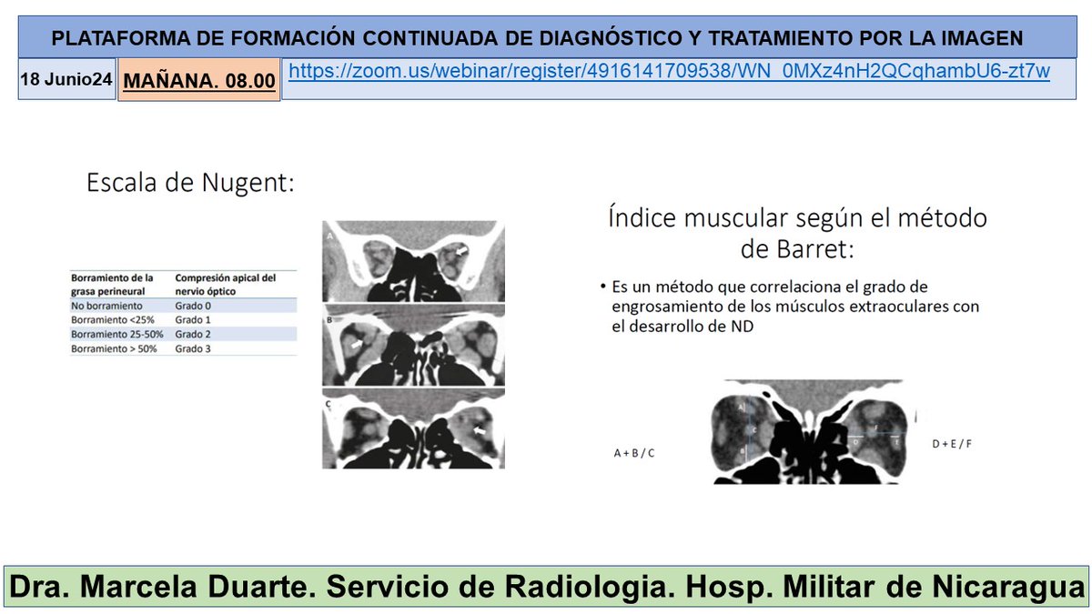salvasapedraza's tweet photo. Interessant sessió de la Dra Marcela Duarte sobre:“ “Orbitopatia tiroïdal: Troballes i indicacions de les tècniques d'imatge” amb moderació de la Dra Yensa Rodríguez @hospitalclinic @SENR_org @idibaps @idibgi @htrueta @gencat @Radiolegs_CAT @seram_rx @iasgirona @AreaHjt @myESR https://t.co/osAD6YrceV