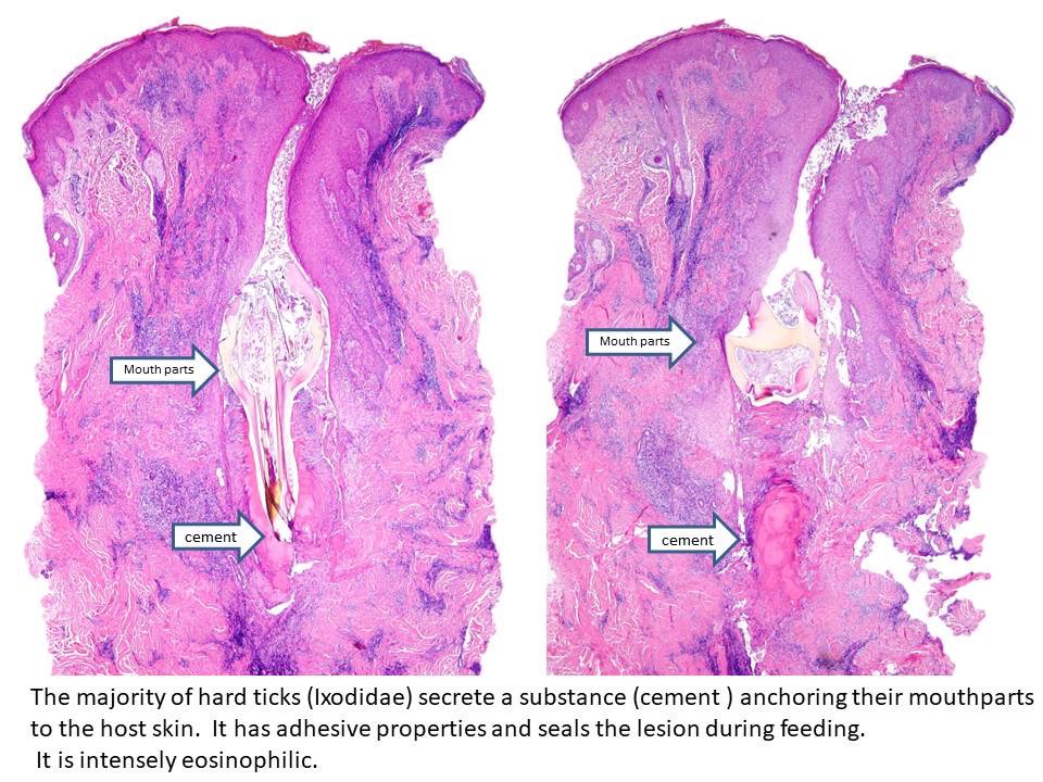 carles_saus's tweet photo. Pruritic nodule after a tick bite. Tick granuloma produced by remains of the tick's mouth. 

Serial sections allow us to see the barbed hypostome, the cement and the inflammatory reaction.

#dermatology; #pathTwitter #tickbite #pathology 
@Histopatolomon @edusqo https://t.co/F8Oe481VGu