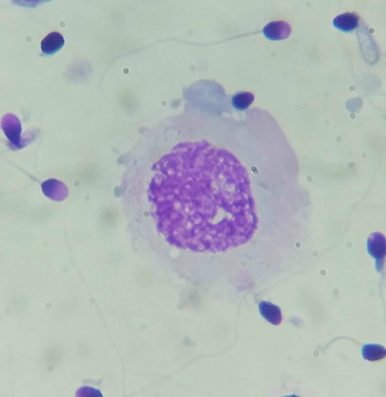 Lisa Andrology Lab Petr贸polis, RJ, Brazil馃嚙馃嚪 (@lisaandrollab) on Twitter photo <a href="/Lisaandrollab/">Lisa Andrology Lab Petr贸polis, RJ, Brazil馃嚙馃嚪</a> images from advanced semen analysis.
Unidentified degenerated atypical cell. Probable round spermatid White nuclear traces with chromosome characteristics. <a href="/Lisaandrollab/">Lisa Andrology Lab Petr贸polis, RJ, Brazil馃嚙馃嚪</a> images from advanced semen analysis.
Unidentified degenerated atypical cell. Probable round spermatid White nuclear traces with chromosome characteristics.