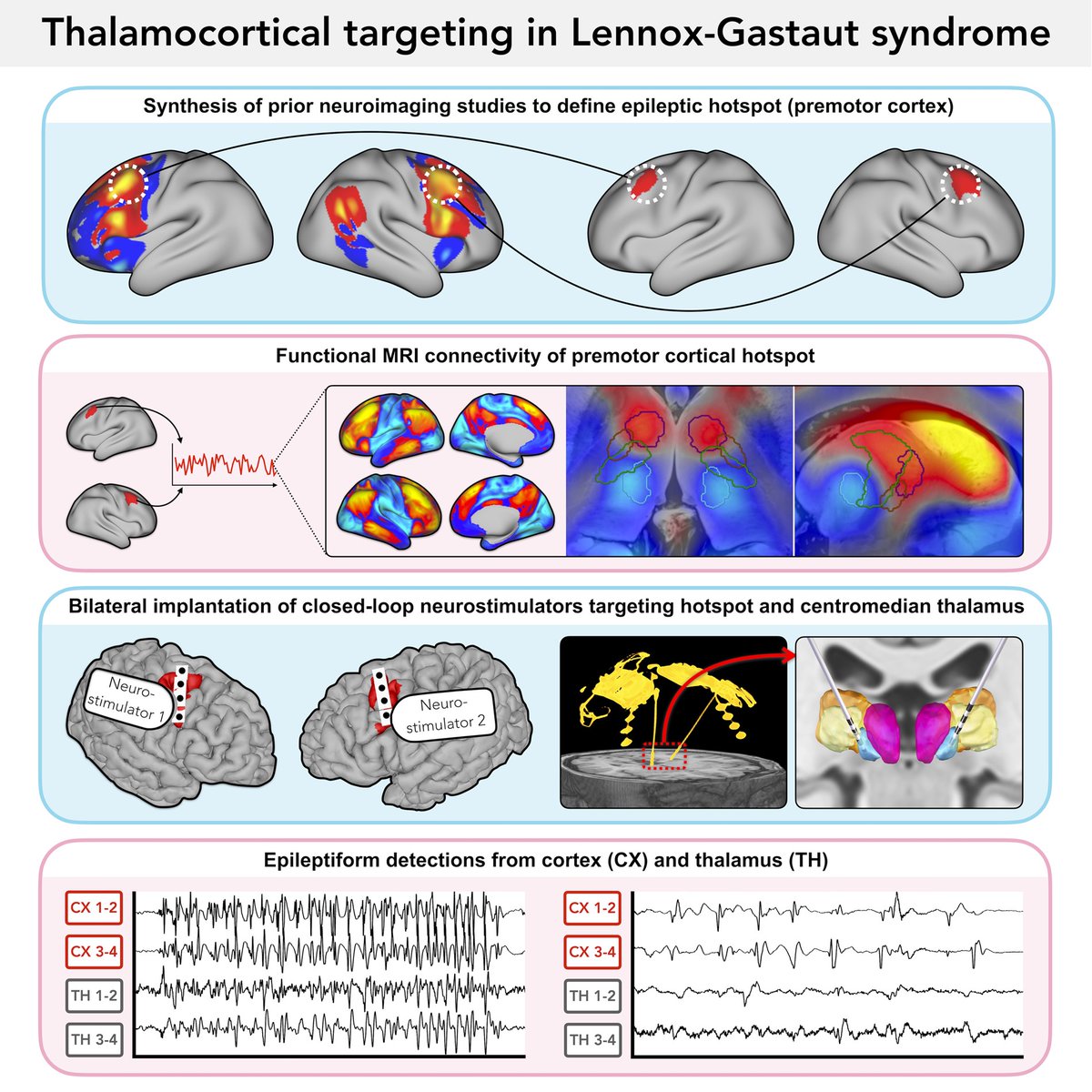 @BrainComms (@braincomms) on Twitter photo Warren et al. outline the neurosurgical technique for a trial of bilateral, closed-loop, thalamocortical stimulation in #LennoxGastautsyndrome. @aaewarren @RolstonJohn <a href="/harvardmed/">Harvard Medical School</a> <a href="/BWHNeurosurgery/">Brigham and Women's Neurosurgery</a>
edin.ac/3VIFwxA Warren et al. outline the neurosurgical technique for a trial of bilateral, closed-loop, thalamocortical stimulation in #LennoxGastautsyndrome. @aaewarren @RolstonJohn <a href="/harvardmed/">Harvard Medical School</a> <a href="/BWHNeurosurgery/">Brigham and Women's Neurosurgery</a>
edin.ac/3VIFwxA