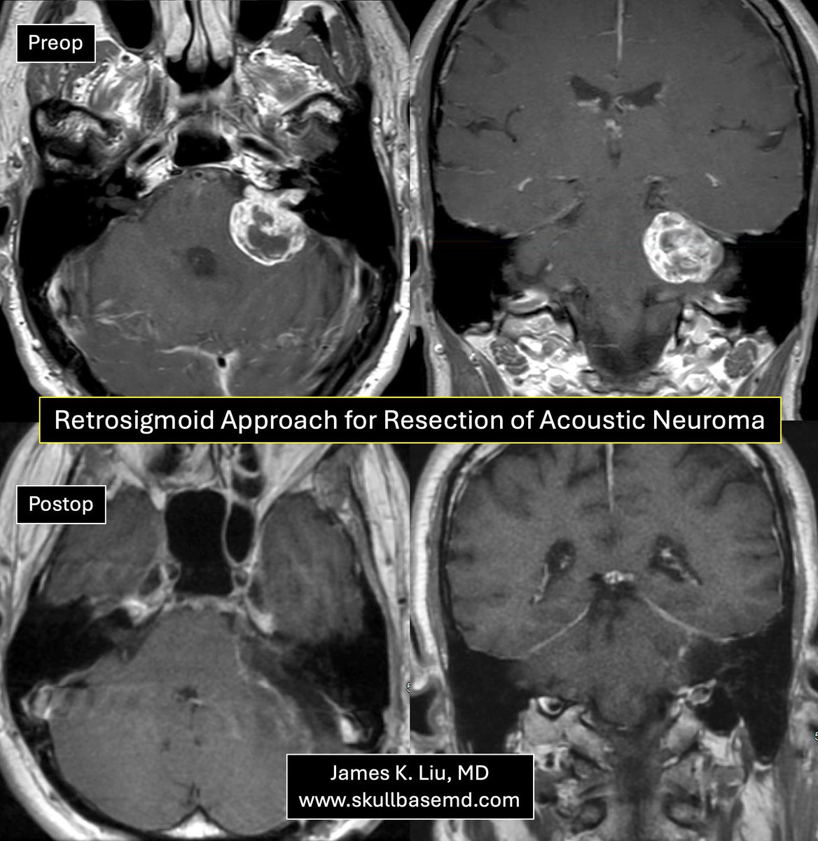 James K. Liu, MD tweet media