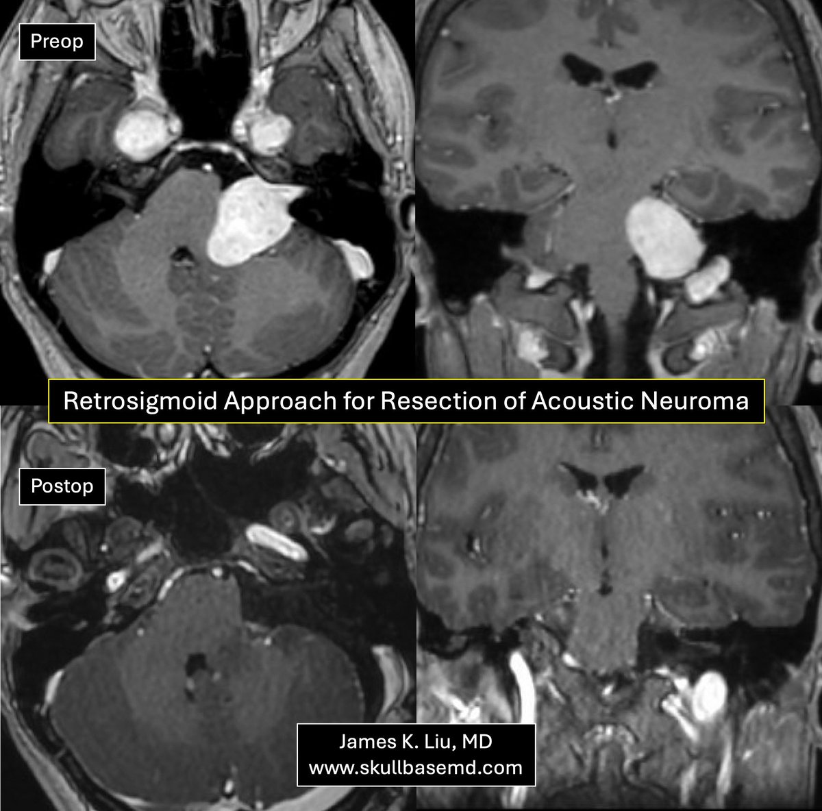 James K. Liu, MD tweet media