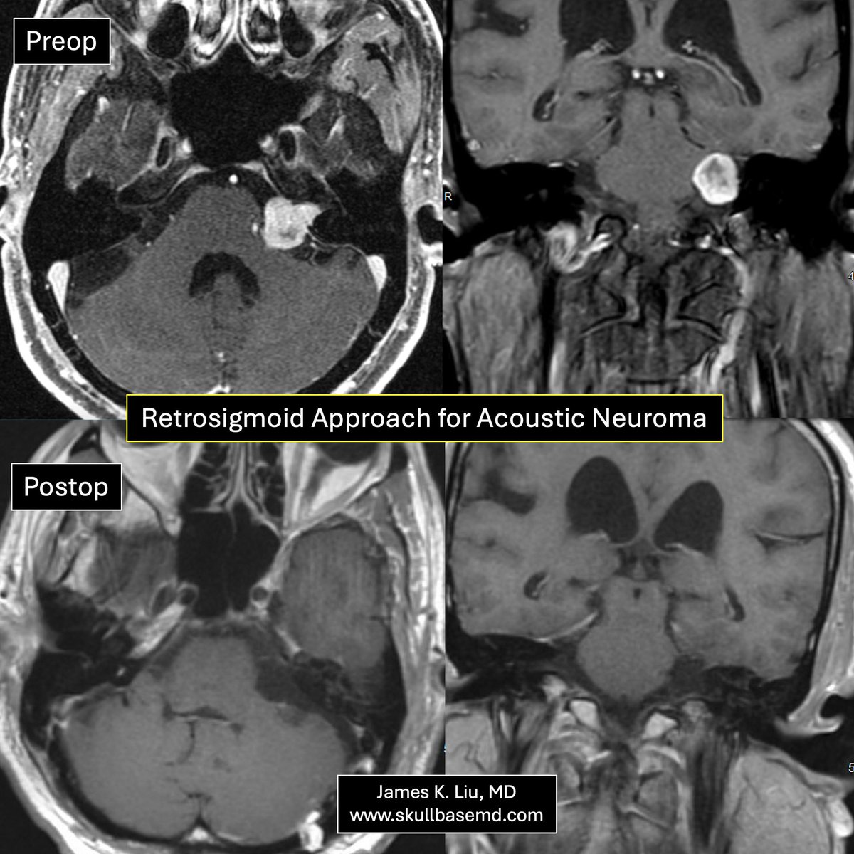 James K. Liu, MD tweet media