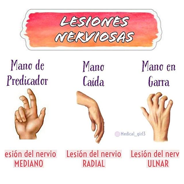 farmacotips's tweet photo. Lesiones nerviosas 🤓

- Mediano → Mano de simio
- Radial → Caída de la muñeca
- Cubital → Mano en garra
- Ciático → Caída del pie
- Torácico largo → Alado de la escápula
- laringe o recurrente → Voz ronca
- Tronco superior → Parálisis de Erb
- Tronco inferior → Parálisis de Klumpke