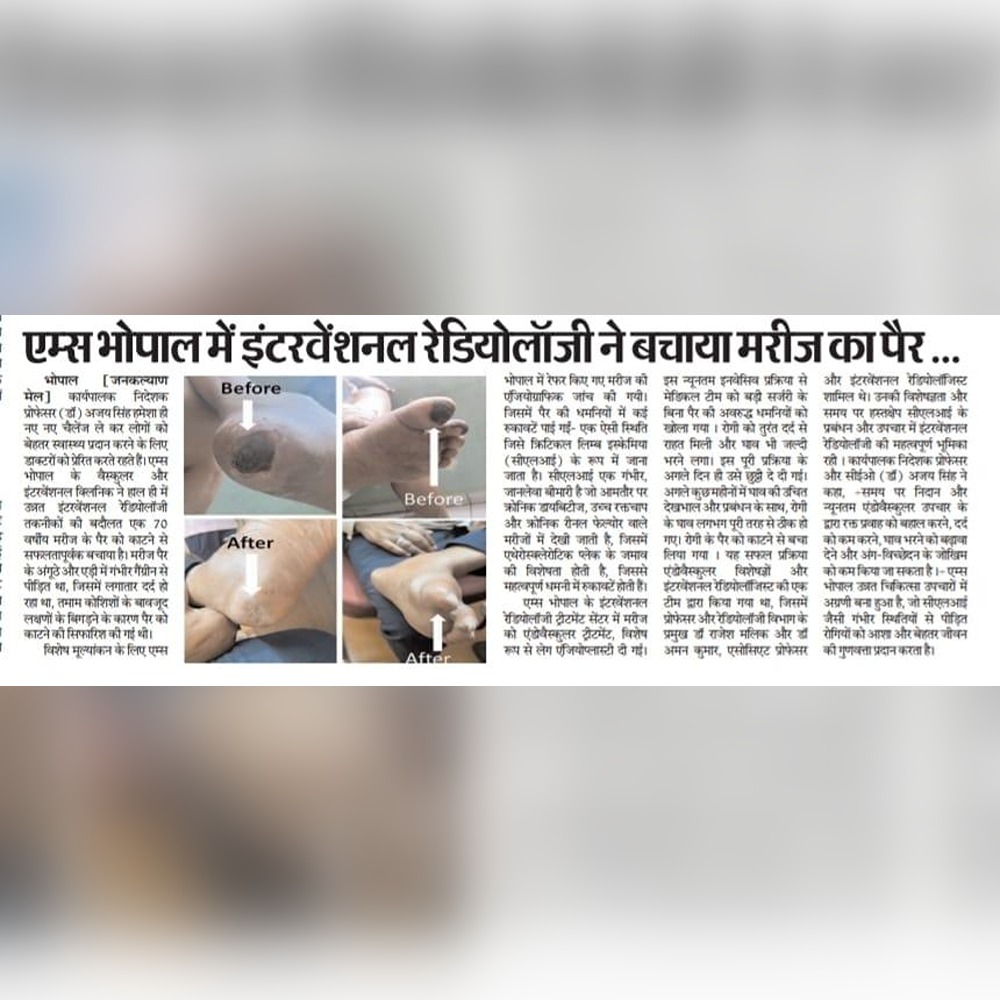 AIIMSBhopal's tweet photo. समाचार पत्रों में एम्स भोपाल 19.06.2024

1. एम्स भोपाल में इंटरवेंशनल रेडियोलॉजी  ने बचाया मरीज का पैर   
2. एम्स में हुआ 70 साल के बुजुर्ग का इलाज, पैर कटने से बचा  
3. निजी अस्पताल में दी गयी थी काटने की सलाह , एम्स में कैथेटर से बचा पैर https://t.co/DqVeHBT2T5
