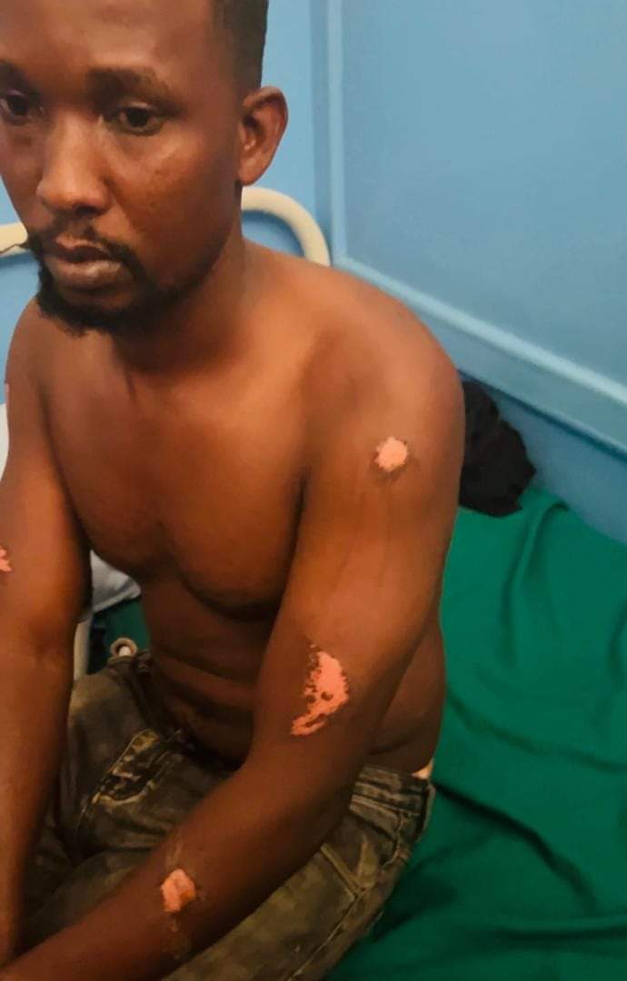 HEBobiwine's tweet photo. This is Mayega Ronald, one of our comrades being tried by the Military Court alongside Olivia Lutaaya and others. He is one of the four who were released on bail, and have been persistently approached by state operatives asking them to 'cooperate with the state' and implicate themselves as having committed the crimes they're charged with. 

On 11th June, he did not return home and his family reported to us about his disappearance. They also reported a case of Disappearance with the Police. For over a week, our Human Rights team alongside his family have been looking for him everywhere including police stations. 

This morning, he resurfaced bearing gruesome wounds. He says that he was abducted by heavily armed men on Tuesday last week. According to his account, they took him to an unknown place where they interrogated him about the ongoing case at the military court, asking him why he has refused to cooperate with them. They asked him why he has repeatedly refused to implicate me and other NUP leaders as having sent them to commit crimes. They tasked him to admit that he committed the offences at the military court and apologize to Gen. Museveni. They promised that if he remains adamant, he will face dire consequences, and if he accepts, he will be given monetary favors. 

Very sadly, he says that two of his captors sodomized him and promised to kill him if he spoke about it😡 (A medical doctor has examined him and confirmed that he was indeed sexually abused)! They would later subject him to untold torture as seen in these pictures. His arms bear clear marks of having been on handcuffs. 

A very sad state of affairs! This is why we cannot give up our pursuit for justice and accountability for these crimes against humanity!