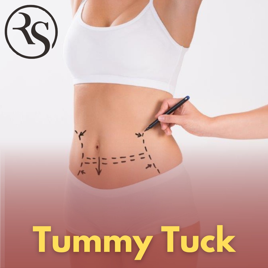 DrRakeshTawar1's tweet image. Follow these guidelines for a smooth recovery and return to your routine quickly.

#TummyTuckRecovery #SurgeryTips #TummyTuck #RecoveryTips #drrakeshtawar #RSAsthetic #dheradun