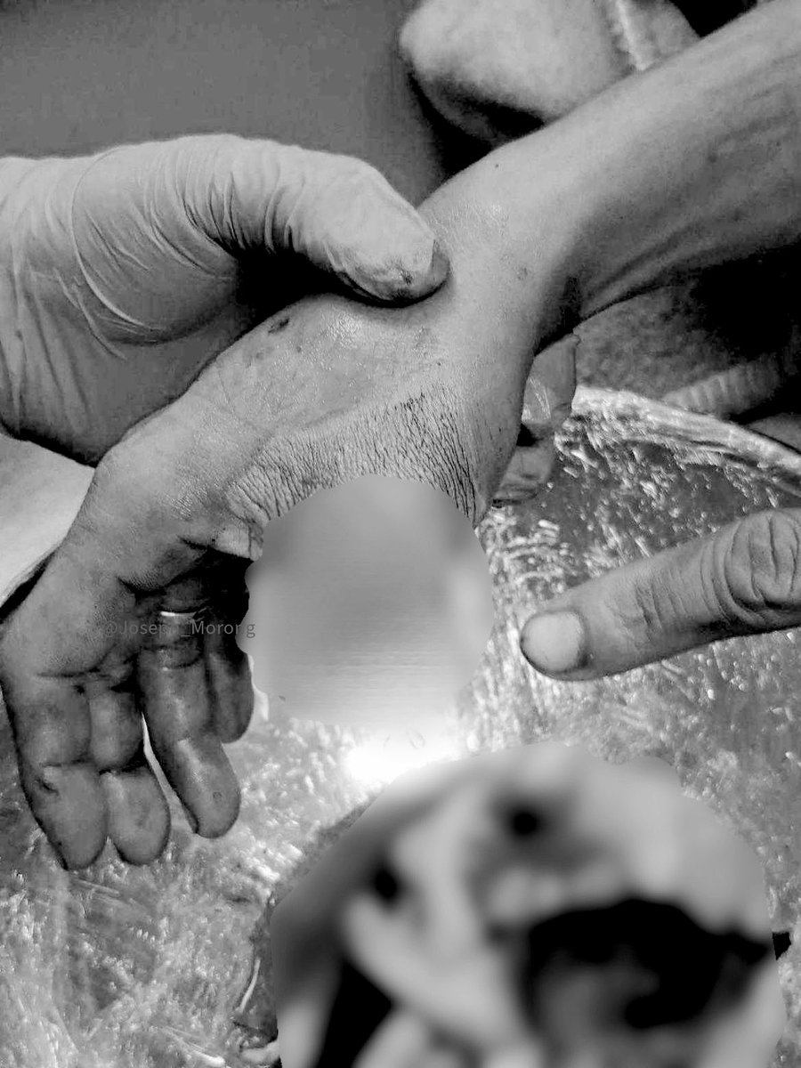 Joseph_Morong's tweet image. WARNING: SENSITIVE CONTENT

CHINA AGGRESSION: Photo shows the hand of a Filipino soldier who lost his thumb when a China Coast Guard inflatable boat rammed into a Philippine boat in a melee during a resupply mission to Ayungin Shoal, June 17 @gmanews @24orasgma