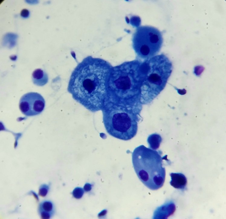 Aggregation of transitional epithelial cells in semen. The transitional epithelium is a lining epithelium restricted to the bladder, ureter and the initial portion of the urethra.  Occasionally its cells are detected in semen.
