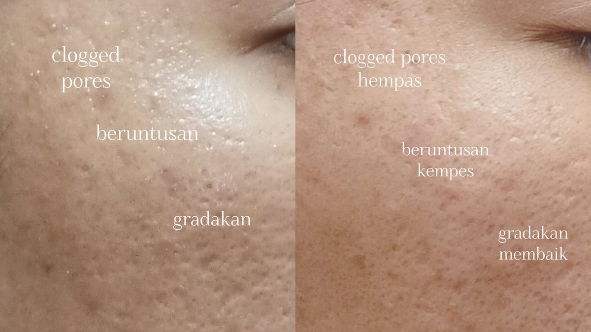 Kunci kulit sehat + jarang komedoan ternyata cuma perlu rutin pakai si merah selama 60 detik

Kalian punya permasalahan kulit yang banyak &amp; gk kunjung selesai? wajib banget sih liat tweet ini