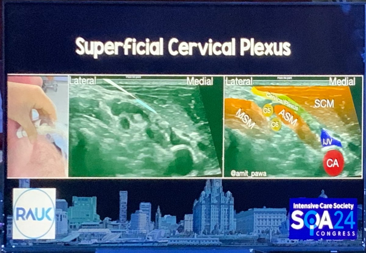 ʇɟıɥsI̍CͨMͫpɐɹɐd ≆ Dr Justin Kirk-Bayley (@paradicmshift) on Twitter photo My favourite start block in ICU, the superficial cervical block. Make those awake line insertions so much more comfortable. So glad it will go into #FUSICblocks
Nicely demonstrated by that legend of sonoanatomy <a href="/amit_pawa/">Dr Amit Pawa💉🎙️</a>
#SOA24 My favourite start block in ICU, the superficial cervical block. Make those awake line insertions so much more comfortable. So glad it will go into #FUSICblocks
Nicely demonstrated by that legend of sonoanatomy <a href="/amit_pawa/">Dr Amit Pawa💉🎙️</a>
#SOA24