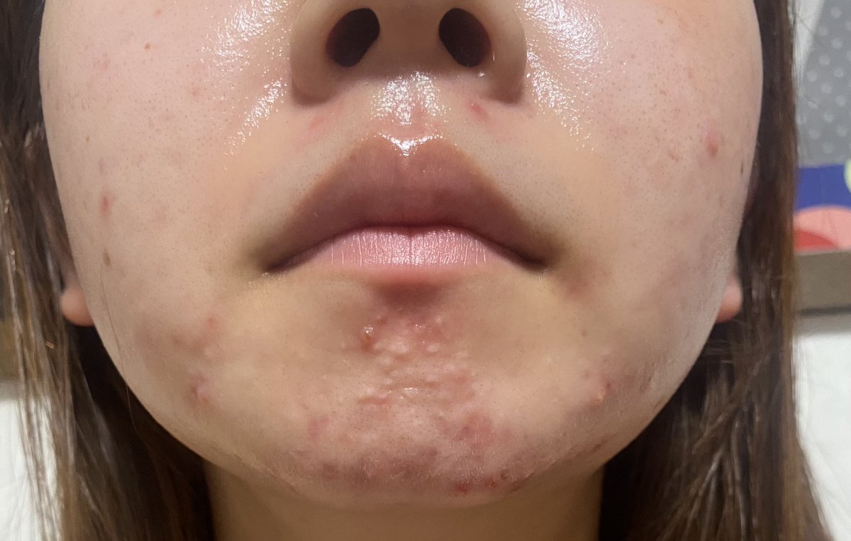 毎年この時期に荒れだすのむり
なんで自分だけこんな悩まないといけないの