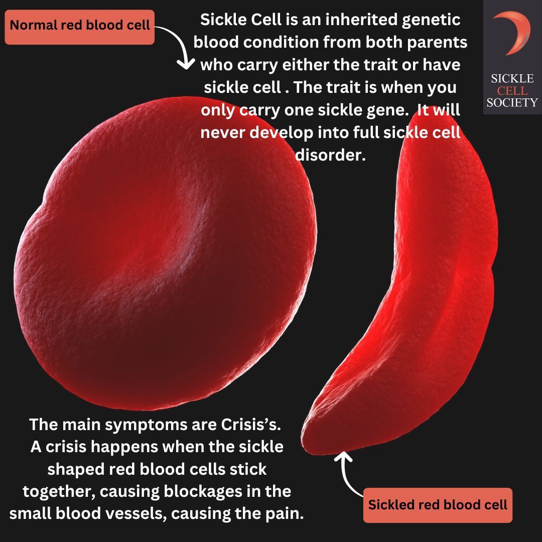 Did you know? Sickle cell disorder is the fastest-growing genetic condition in the UK, affecting around 17,500 people. It causes red blood cells to become sickle-shaped, blocking blood flow, leading to severe pain . More on our website buff.ly/45uA5XA 
#WorldSickleCellDay