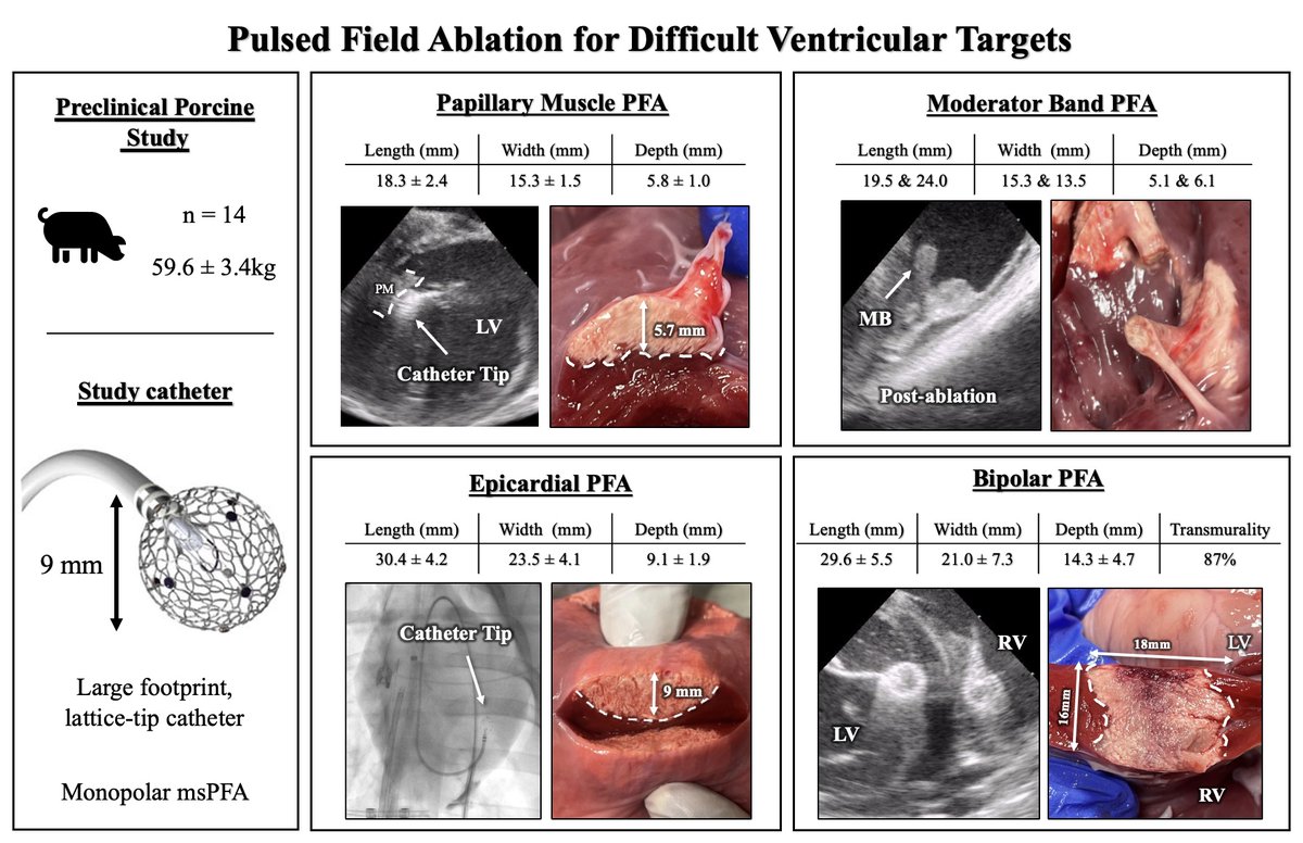 Ablation of difficult ventricular targets with pulsed field ablation: Creating transmural ventricular lesions and ablating intracavitary structures <a href="/MoritzNies/">Moritz Nies</a> <a href="/iwanari65284818/">Iwanari Kawamura</a> <a href="/SantosGallegoMD/">Carlos G Santos-Gallego, MD</a> <a href="/VivekReddyMD/">Vivek Y. Reddy</a> <a href="/jskoruth/">Jacob Koruth</a> #AHAJournals #Epeeps
doi.org/10.1161/CIRCEP…