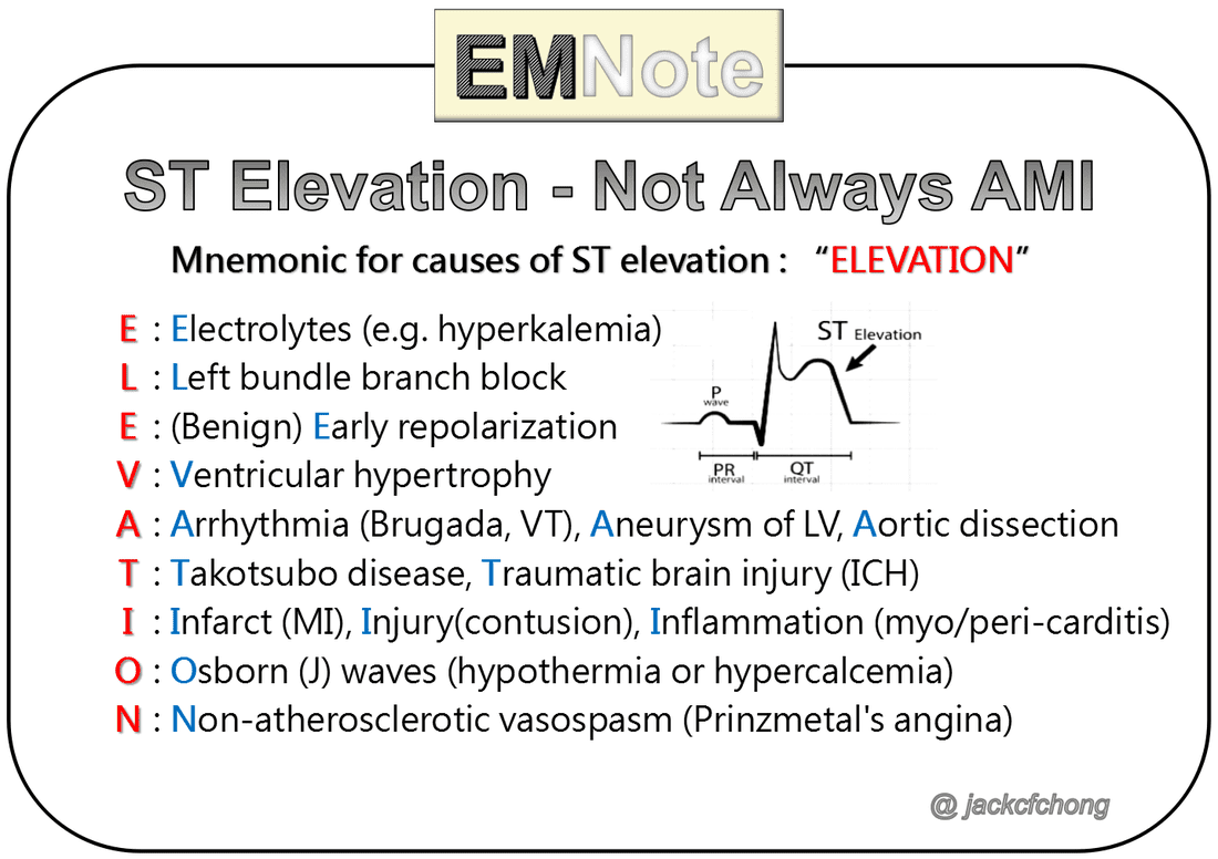 jackcfchong's tweet photo. ST elevation not always STEMI. 
Click this link to learn ECGs that mimic STEMI:
https://t.co/ipflGiV6Z4 https://t.co/wlR26Bb217