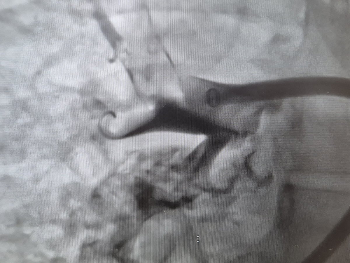 AsherElad's tweet photo. 52 y.o male present with syncope and swollen rt. Leg. On CT saddle PE. Thrombectony with INARI. 
With @dannydvir @EmiLev184

@PCRonline @Sbrugaletta @Ortega_Paz @Anazmicalik @guilbom @hect2701 @NicolaRyanI1 @DrPascalMeier @W_jyg @ICigalini @Hragy @SABOURETCardio
@mmamas1973 @djc795 @GreggWStone @toreyj01 @EAPCIPresident @CMichaelGibson @SmithElliotjs @ArielRoguin