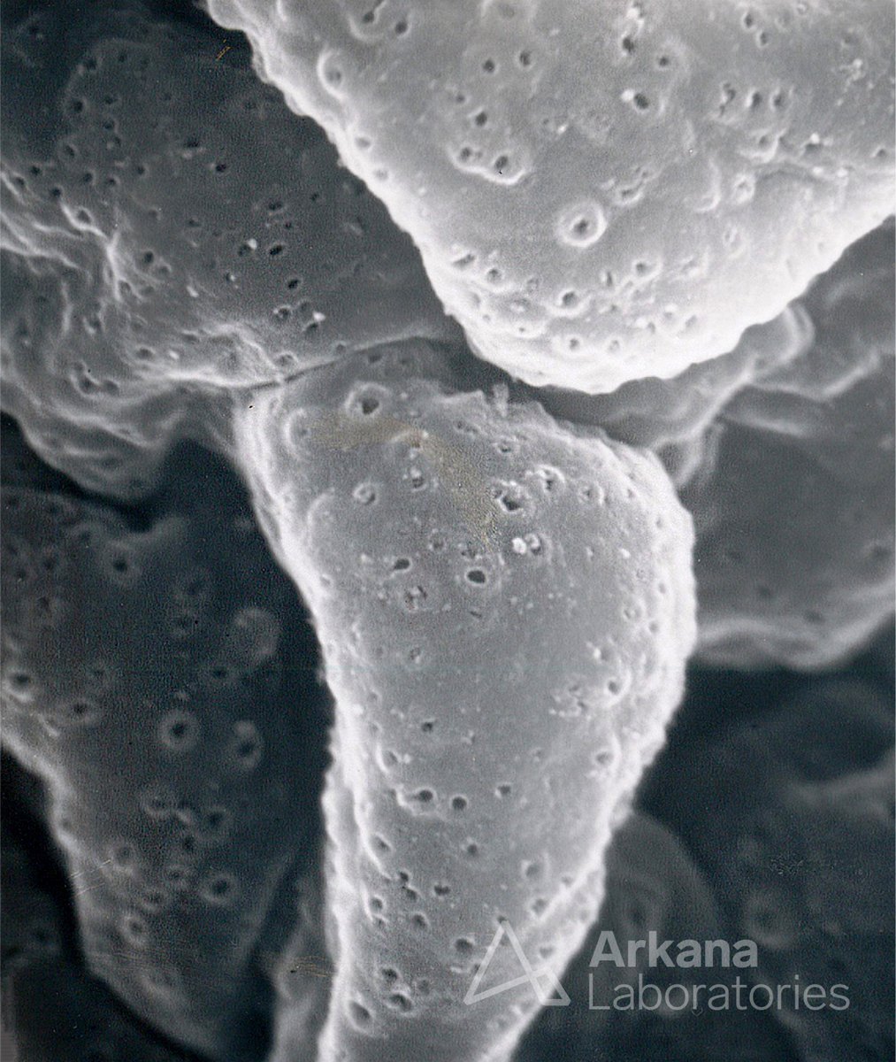arkanalabs's tweet photo. Today’s #eyeSCANdy shows an acellular scanning EM from a biopsy with membranous glomerulonephritis stage I, showing numerous small shallow depressions representing the site of immune complexes which were extracted.

Photo courtesy of Dr. Stephen Bonsib. #PathTwitter #PathX https://t.co/InpriLnZUf