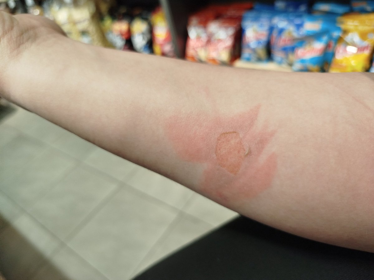 some_pidor's tweet image. Это мне теперь будет уроком не ходить босиком после душа по линолеуму, ещё и на кухне, пока у меня не остыла конфорка