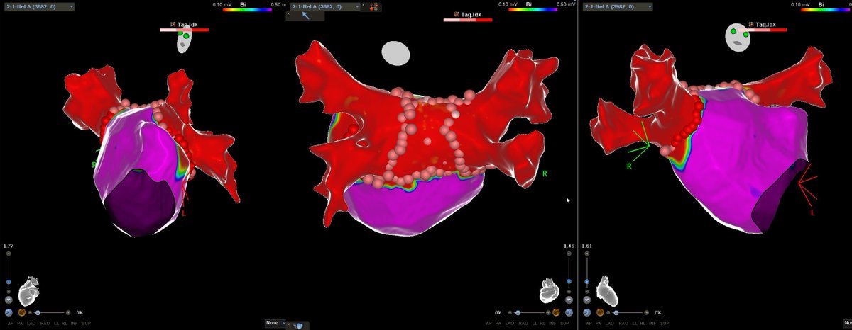 ACuevaParra's tweet photo. 📌 Ablación de fibrilación auricular persistente, en un paciente de 60 años, con antecedente de ablación previa hace 5 años. Gracias a mis CAS @AngelSV28 @BiosenseWebster #EPepes #Carto3 https://t.co/fOmyqu9Qk6