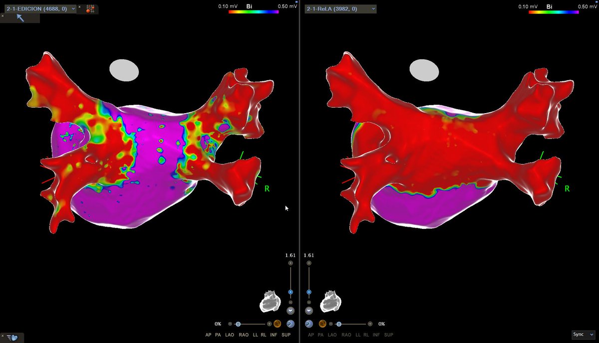 ACuevaParra's tweet photo. 📌 Ablación de fibrilación auricular persistente, en un paciente de 60 años, con antecedente de ablación previa hace 5 años. Gracias a mis CAS @AngelSV28 @BiosenseWebster #EPepes #Carto3 https://t.co/fOmyqu9Qk6