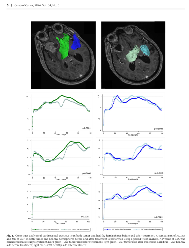 KingsNeuro's tweet photo. Publication Alert!
We have now published on "Ultra-early navigated transcranial magnetic stimulation for perioperative stroke: anatomo-functional report" in Cerebral Cortex @OxfordJournals.
Read more: https://t.co/737S0m7aiV
@Sabzp87 @lavrador_jose @dim_kalaitzo @flaviodellacqua https://t.co/lgcr62q4ul
