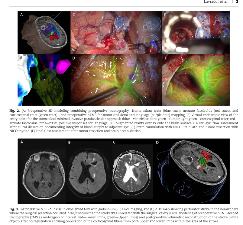 Publication Alert!
We have now published on "Ultra-early navigated transcranial magnetic stimulation for perioperative stroke: anatomo-functional report" in Cerebral Cortex <a href="/OxfordJournals/">Oxford Journals</a>.
Read more: doi.org/10.1093/cercor…
<a href="/Sabzp87/">Sabina</a> <a href="/lavrador_jose/">José Pedro Lavrador</a> <a href="/dim_kalaitzo/">Dimitris Kalaitzoglou</a> <a href="/flaviodellacqua/">Flavio Dell'Acqua</a>