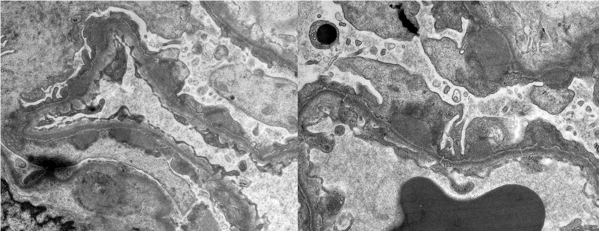 Jonathan Zuckerman MD PhD (@jzrenalpath) on Twitter photo When 1 diagnosis just isn't enough. Pt with sub nephrotic proteinuria and BMI of 40. Glomerulomegaly c/w obesity related glomerulopathy, surprise PLA2R+MN, and thin GBM lesion. Death by 1000 cuts. #renalpath #nephropathy #pathtwitter When 1 diagnosis just isn't enough. Pt with sub nephrotic proteinuria and BMI of 40. Glomerulomegaly c/w obesity related glomerulopathy, surprise PLA2R+MN, and thin GBM lesion. Death by 1000 cuts. #renalpath #nephropathy #pathtwitter