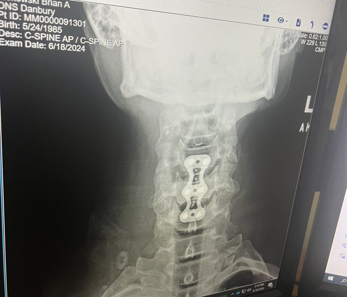 AnthonyArmy's tweet photo. 2 week Post-op went great!     

X-Rays look good…. Recovery on point…no signs of infection @ surgical site … &amp; I’m partially bionic now 🤣 

Huge thanks to all @newwrestling1 fans (in addition to friends/fam ) who have continued to check in/message me.  It means a lot!

💚 https://t.co/VqOmXh4z6b