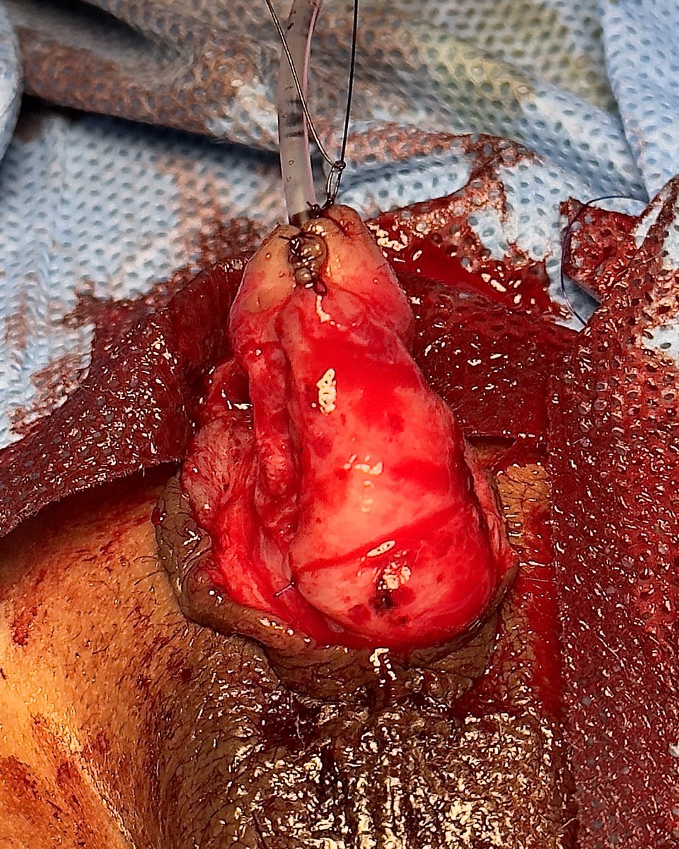 lachicadeuro's tweet image. Pedicle preputial tube done around the catheter, proximal and distal anastomosis done. The pedicle covers the suture lines👇🏽

#hypospadias #flaps #grafts #reconstructive